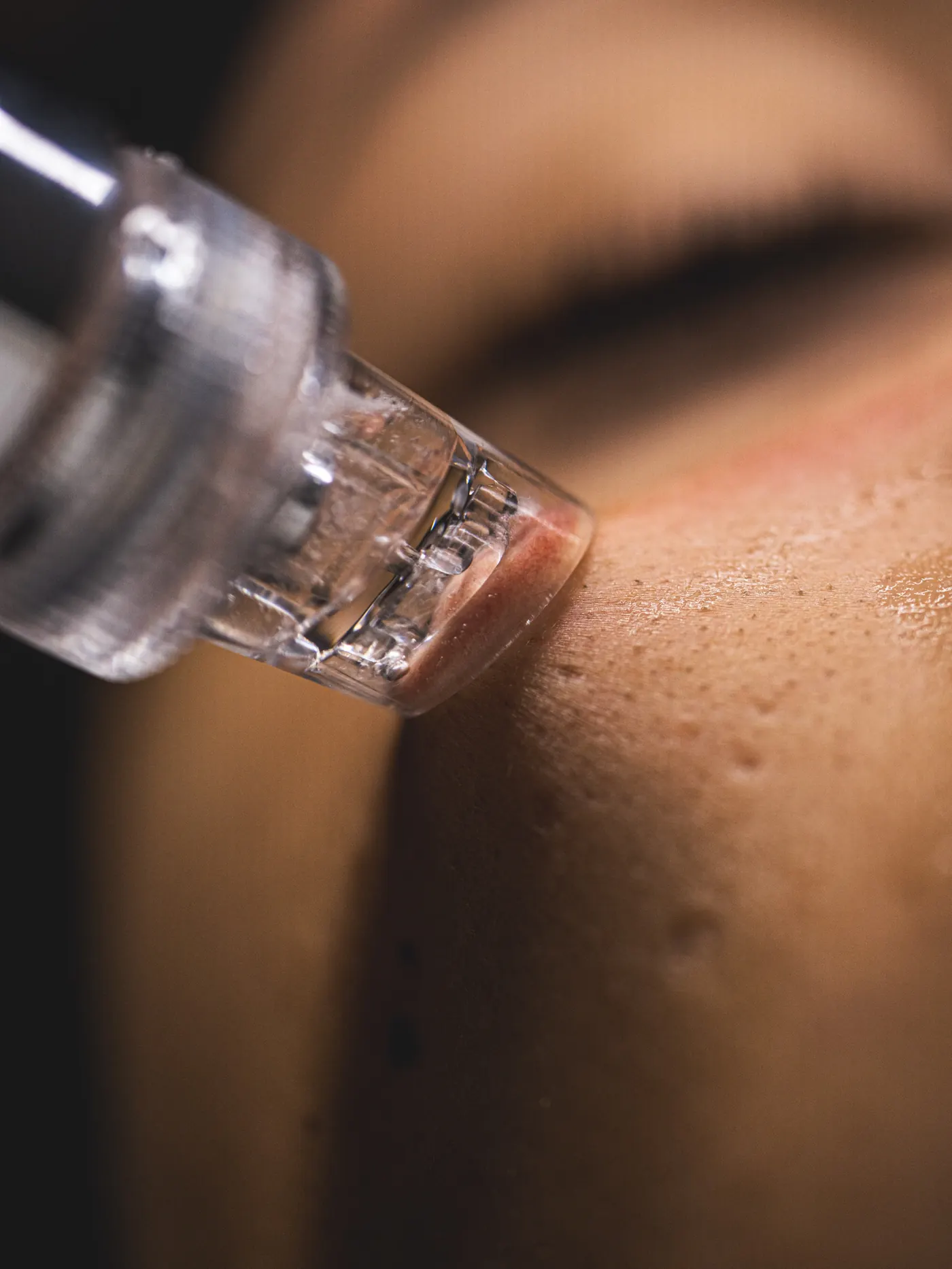 Aplicación de Dermapen sobre la piel